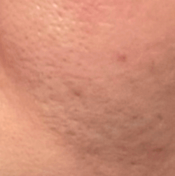 pores1